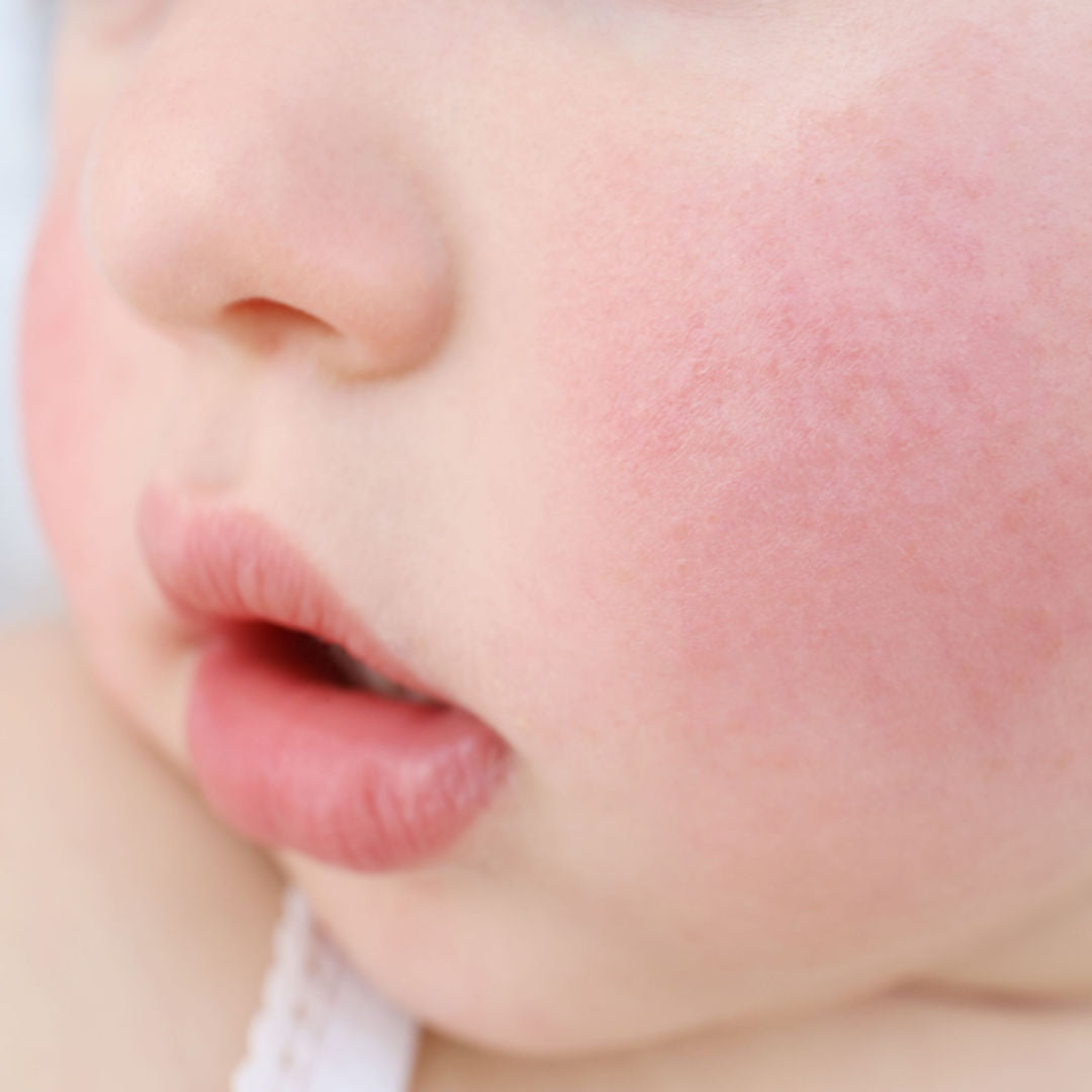 Why are my baby’s cheeks so red?
